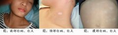 白癜风能不能治好？该怎么治疗？